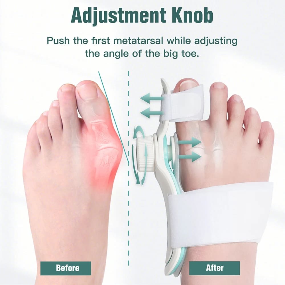 Orthopedic bunion corrector, hallux valgus corrector on the foot